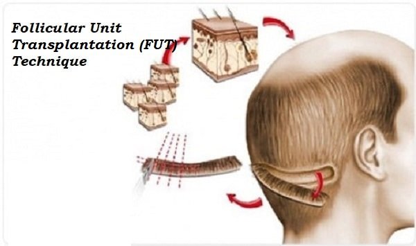 FUT (Follicular Unit Transplantation)