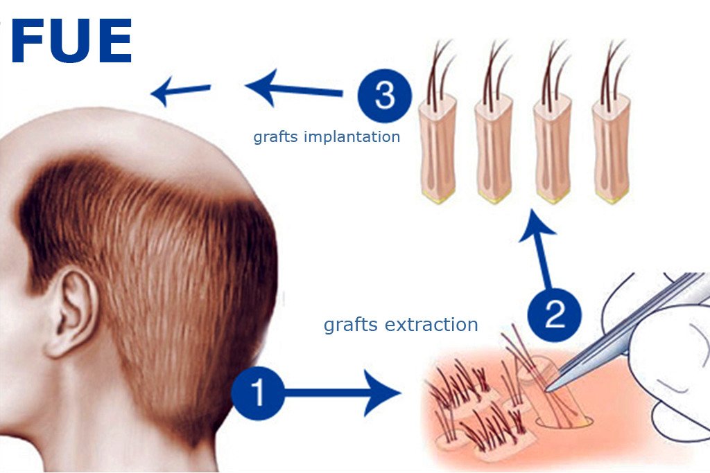 Hair Transplant- Surgical techniques