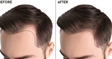 Surgical Treatment for Hair Transplant